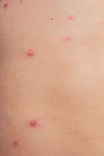 istock Chicken pox on child skin 598921698