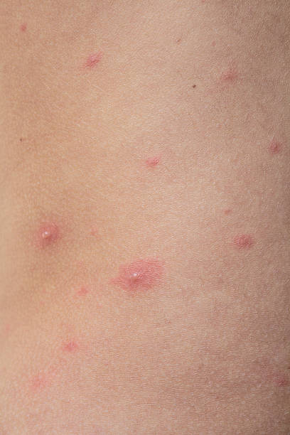 istock Chicken pox on child skin 598922156