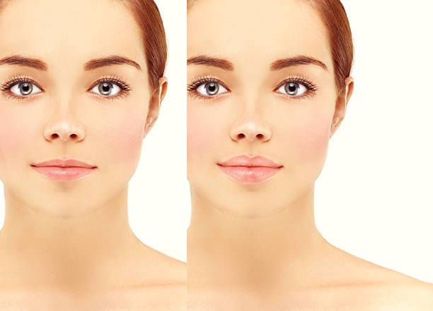 istock Before and after lip injections. 598934550