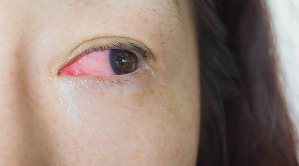 istock The human eye with symptoms of conjunctivitis 598957558