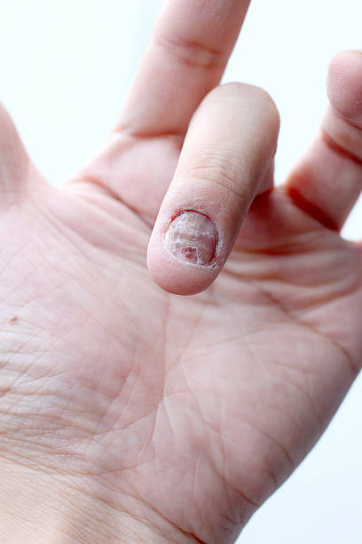 istock Fungus Infection on Nails Hand, Finger with onychomycosis. 598958280