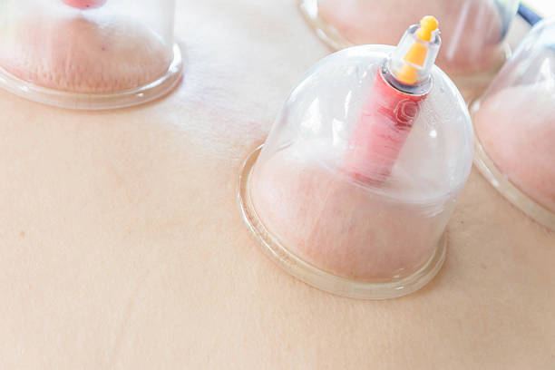 istock chinese tradition treatment, vacuum cupping treatment 598958960