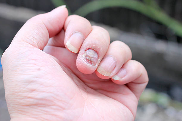 istock Fungus Infection on Nails Hand, Finger with onychomycosis. 598959408