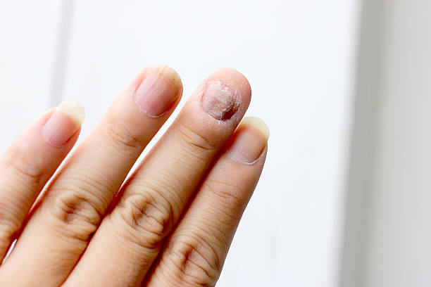 Fungus Infection on Nails Hand, Finger with onychomycosis. Fungus Infection on Nails Hand, Finger with onychomycosis. - soft focusFungus Infection on Nails Hand, Finger with onychomycosis. - soft focus trichophyton fungus stock pictures, royalty-free photos & images