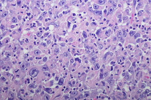 Microscopic photograph of a professionally prepared slide demonstrating renal cell carcinoma with rhabdoid differentiation
