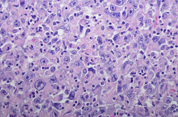 rak nerkowy z różnicowanie rabdoidów - kidney cancer zdjęcia i obrazy z banku zdjęć