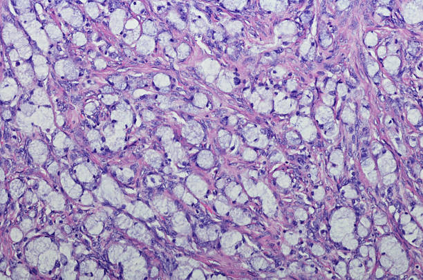 Adenocarcinoma ex-goblet cell carcinoid of the appendix