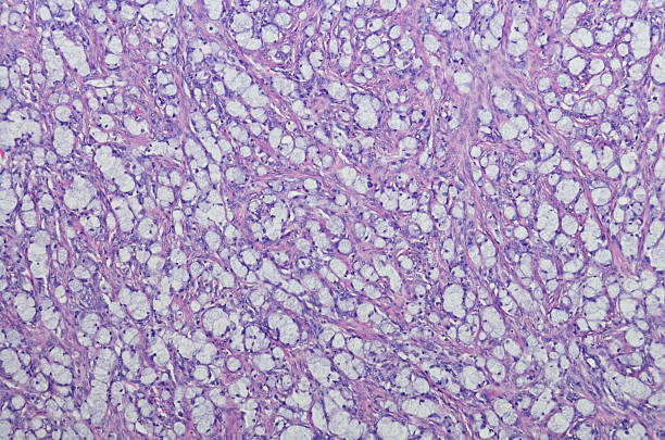 istock Adenocarcinoma ex-goblet cell carcinoid of the appendix 599123390