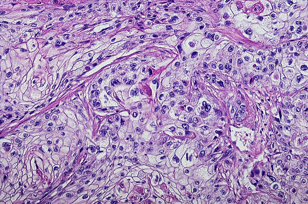 micrografía del carcinoma de células escamosas de la cabeza y el cuello - microscope slide fotografías e imágenes de stock