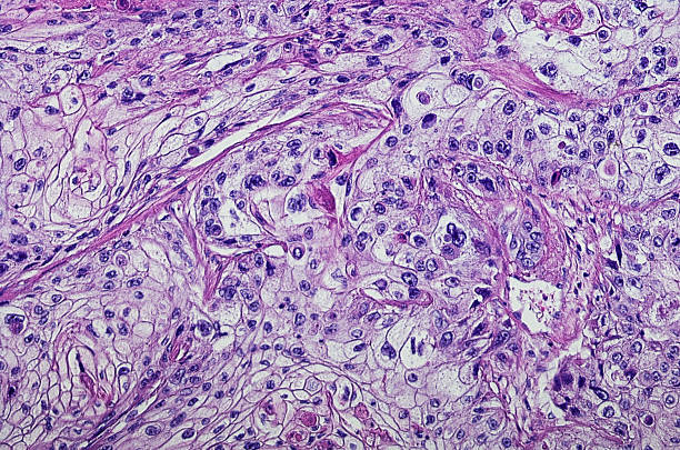 istock Micrograph of squamous cell carcinoma of the head and neck 599131504