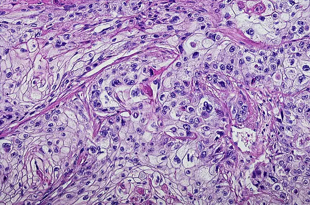 Photo of Micrograph of squamous cell carcinoma of the head and neck