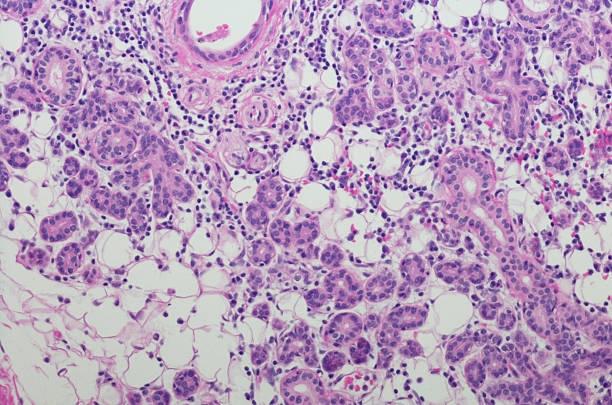 istock Micrograph of Acinic cell carcinoma with high grade transformation 599134766