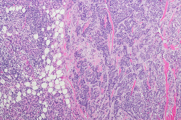 istock Micrograph of Acinic cell carcinoma with high grade transformation 599134798