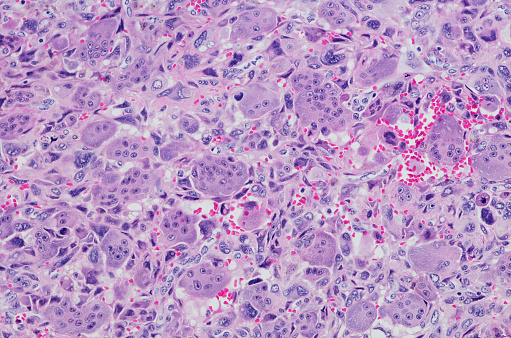 Micrograph of Giant cell rich extraskeletal osteosarcoma of the shoulder. Giant cell rich osteosarcoma is a relatively unusual histological form of osteosarcoma, common lesion usually presenting in the long bones of the appendicular skeleton. Histologically, this tumor tends to be a highly anaplastic, pleomorphic tumor in which the tumor cells may be: plasmacytoid, fusiform, ovoid, small round cells, clear cells, mono-or multinucleated giant cells, or, spindle cells.