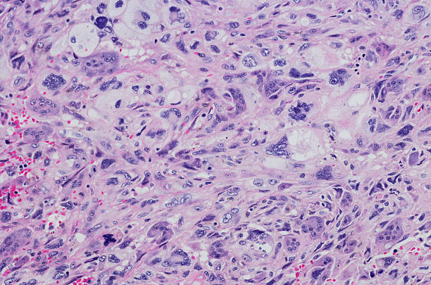 istock Micrograph  giant cell rich extraskeletal osteosarcoma of the shoulder 599143394