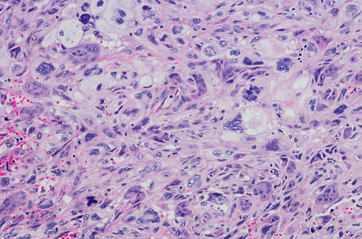 Micrograph of Giant cell rich extraskeletal osteosarcoma of the shoulder. Giant cell rich osteosarcoma is a relatively unusual histological form of osteosarcoma, common lesion usually presenting in the long bones of the appendicular skeleton. Histologically, this tumor tends to be a highly anaplastic, pleomorphic tumor in which the tumor cells may be: plasmacytoid, fusiform, ovoid, small round cells, clear cells, mono-or multinucleated giant cells, or, spindle cells.