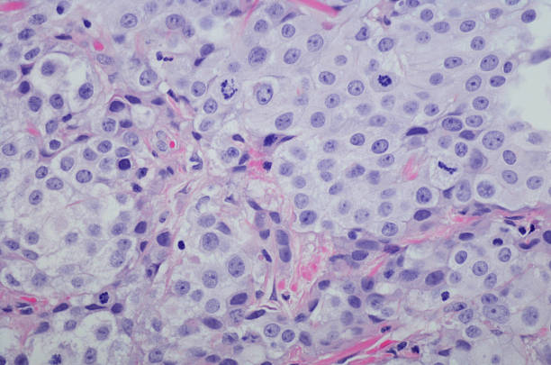 Micrograph Invasive urothelial carcinoma high grade. H&E Stain Micrograph of Invasive urothelial carcinoma high grade. Invasive urothelial carcinoma is a type of Transitional cell carcinoma (TCC, also urothelial cell carcinoma or UCC) and is a type of cancer that develops in the urinary system: the kidney, urinary bladder, and accessory organs. It is the most common type of bladder cancer and cancer of the ureter, urethra, and urachus. Invasive urothelial carcinoma originates from tissue lining the inner surface of these hollow organs - transitional epithelium. It can extend from the kidney collecting system to the bladder. H&E Stain light micrograph photos stock pictures, royalty-free photos & images