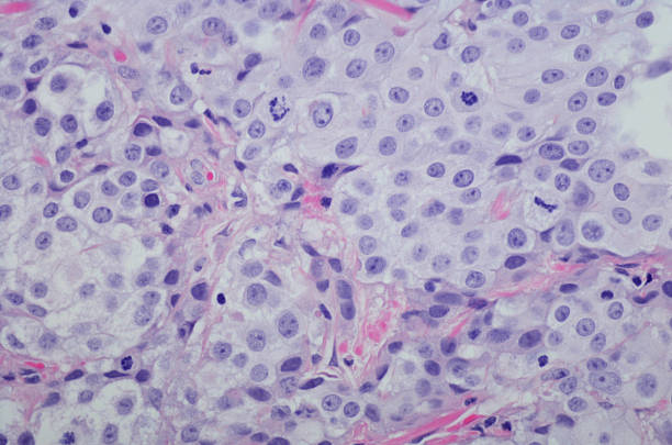 Micrograph Invasive urothelial carcinoma high grade. H&E Stain Micrograph of Invasive urothelial carcinoma high grade. Invasive urothelial carcinoma is a type of Transitional cell carcinoma (TCC, also urothelial cell carcinoma or UCC) and is a type of cancer that develops in the urinary system: the kidney, urinary bladder, and accessory organs. It is the most common type of bladder cancer and cancer of the ureter, urethra, and urachus. Invasive urothelial carcinoma originates from tissue lining the inner surface of these hollow organs - transitional epithelium. It can extend from the kidney collecting system to the bladder. H&E Stain magnification high scale magnification scientific micrograph cell stock pictures, royalty-free photos & images