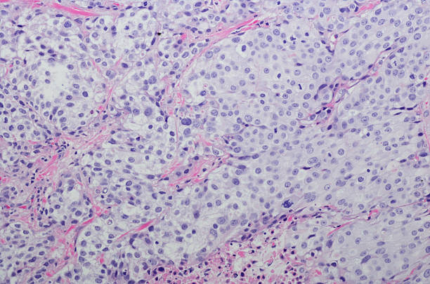 Micrograph Invasive urothelial carcinoma high grade. H&E Stain Micrograph of Invasive urothelial carcinoma high grade. Invasive urothelial carcinoma is a type of Transitional cell carcinoma (TCC, also urothelial cell carcinoma or UCC) and is a type of cancer that develops in the urinary system: the kidney, urinary bladder, and accessory organs. It is the most common type of bladder cancer and cancer of the ureter, urethra, and urachus. Invasive urothelial carcinoma originates from tissue lining the inner surface of these hollow organs - transitional epithelium. It can extend from the kidney collecting system to the bladder. H&E Stain urothelium stock pictures, royalty-free photos & images