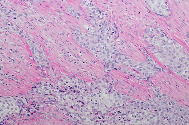 Micrograph Invasive urothelial carcinoma high grade. H&E Stain Micrograph of Invasive urothelial carcinoma high grade. Invasive urothelial carcinoma is a type of Transitional cell carcinoma (TCC, also urothelial cell carcinoma or UCC) and is a type of cancer that develops in the urinary system: the kidney, urinary bladder, and accessory organs. It is the most common type of bladder cancer and cancer of the ureter, urethra, and urachus. Invasive urothelial carcinoma originates from tissue lining the inner surface of these hollow organs - transitional epithelium. It can extend from the kidney collecting system to the bladder. H&E Stain urothelium stock pictures, royalty-free photos & images