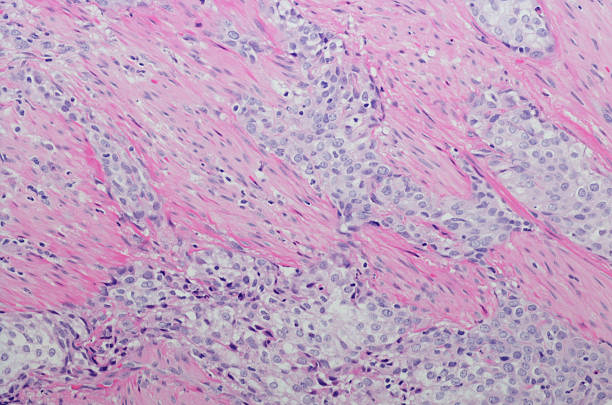 Micrograph Invasive urothelial carcinoma high grade. H&E Stain Micrograph of Invasive urothelial carcinoma high grade. Invasive urothelial carcinoma is a type of Transitional cell carcinoma (TCC, also urothelial cell carcinoma or UCC) and is a type of cancer that develops in the urinary system: the kidney, urinary bladder, and accessory organs. It is the most common type of bladder cancer and cancer of the ureter, urethra, and urachus. Invasive urothelial carcinoma originates from tissue lining the inner surface of these hollow organs - transitional epithelium. It can extend from the kidney collecting system to the bladder. H&E Stain magnification high scale magnification scientific micrograph cell stock pictures, royalty-free photos & images