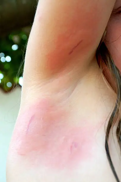 Child showing an injury under its arm: a burn/sting of a jellyfish. Adriatic sea.