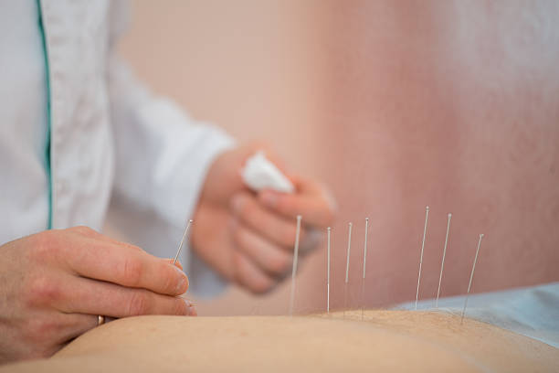 침술 치료, 환자에게 의료 용 바늘 배치, 클로즈업 - acupuncture needle 뉴스 사진 이미지