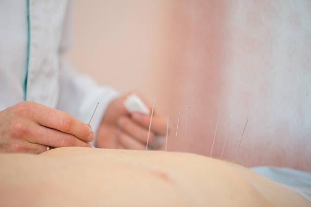 trattamenti di agopuntura, posizionamento di aghi medici sul paziente, primi piani - acupuncture spa treatment asian culture medicine foto e immagini stock