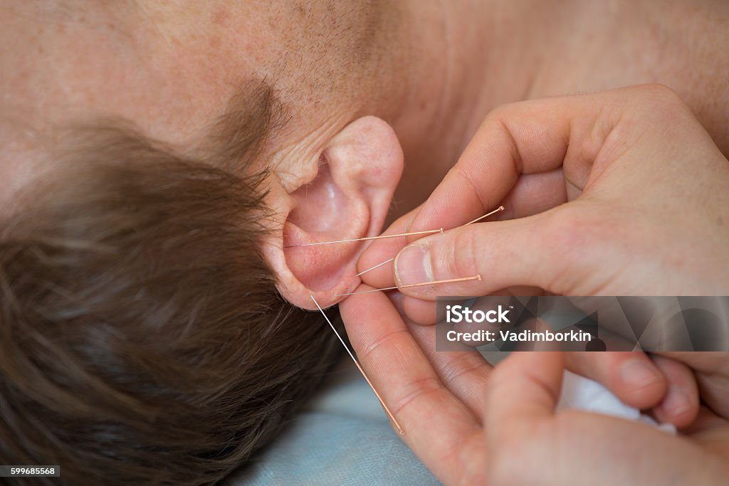 acupuncture treatments, placement of medical needles on the patient, close-ups Photo of acupuncture treatments, placement of medical needles on the patient, close-ups Acupuncture Stock Photo