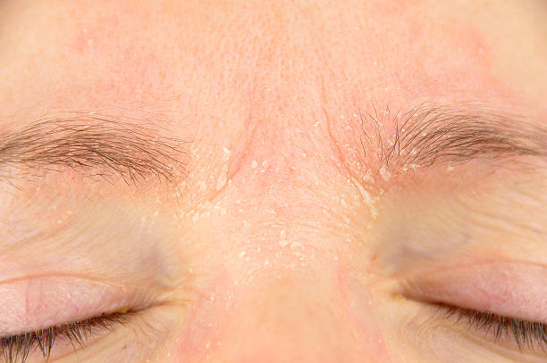 istock woman with atopic dermatitis 599709086