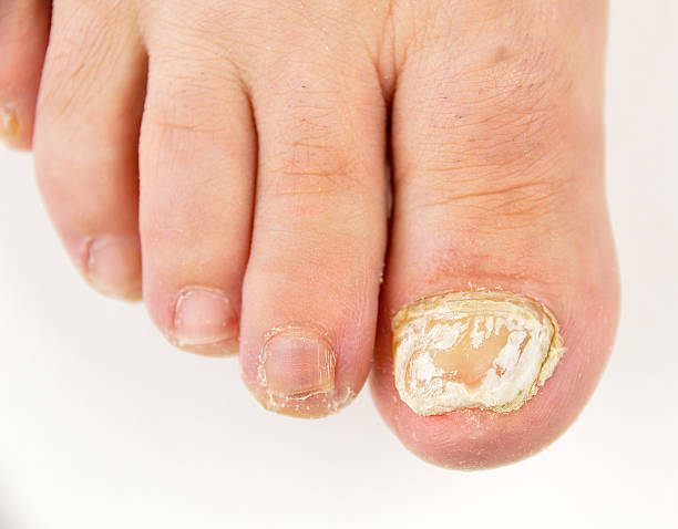 ネイルの菌 - fungus toenail human foot onychomycosis ストックフォトと画像