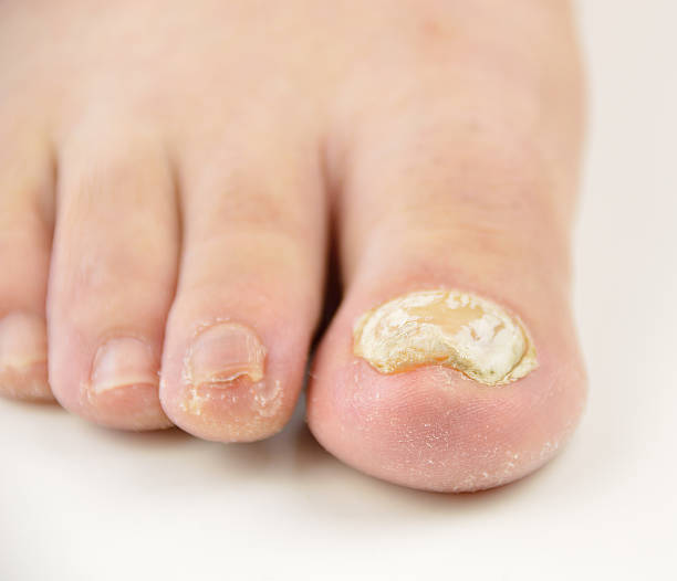 nagel-pilz - podiatry chiropody toenail human foot stock-fotos und bilder