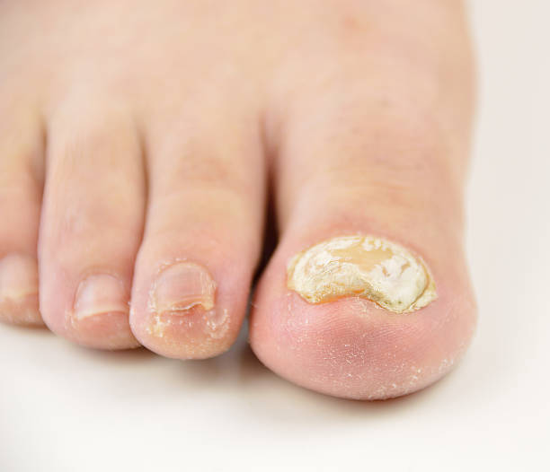 paznokieć grzyb - podiatry chiropody toenail human foot zdjęcia i obrazy z banku zdjęć