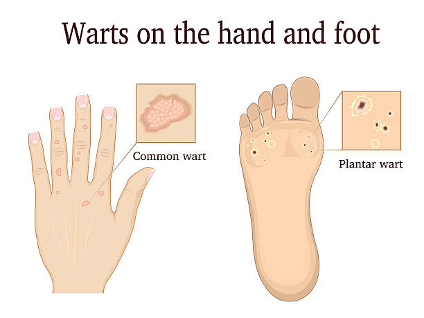 Warts on the hand and foot Warts on the hand and foot depicted in general and close-up wart stock illustrations