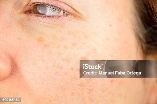 istock skin of woman with blemish and spots 600165480