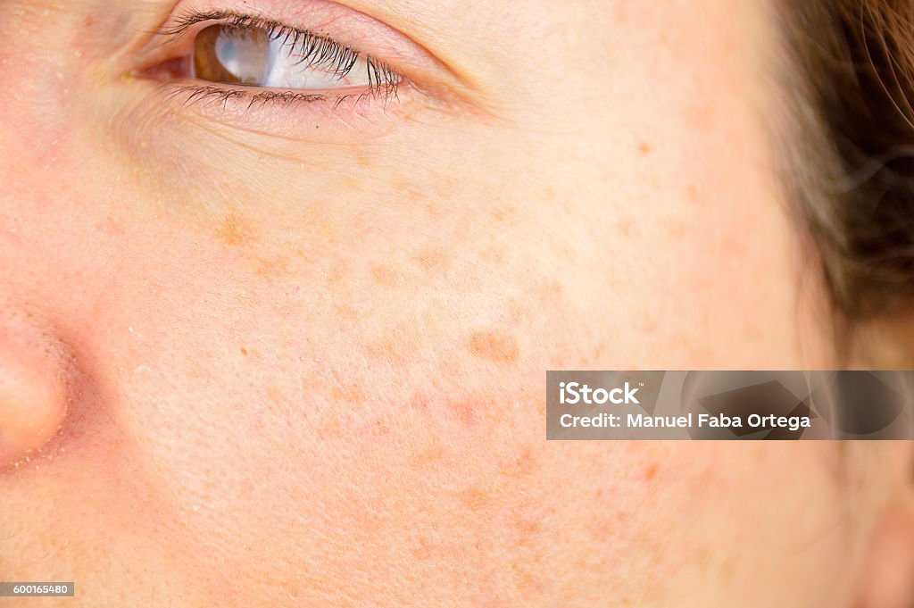 skin of woman with blemish and spots closeup of a woman cheek with liver spot causes by the large exposition sun Liver Spot Stock Photo