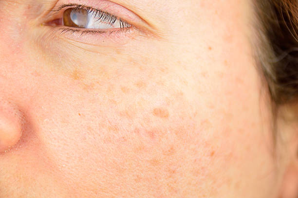 skin of woman with blemish and spots closeup of a woman cheek with liver spot causes by the large exposition sun freckle photos stock pictures, royalty-free photos & images