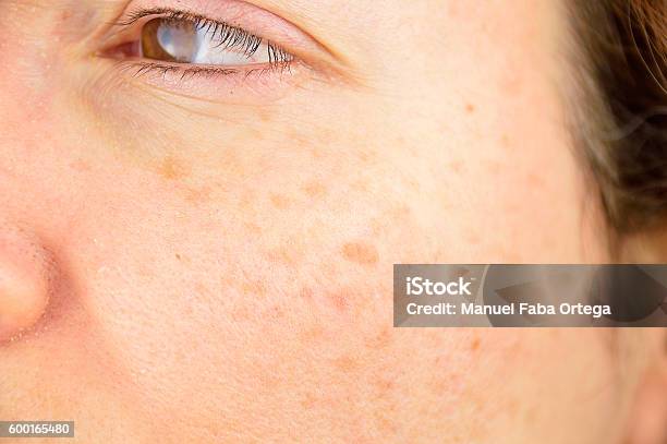 Skin Of Woman With Blemish And Spots Stock Photo - Download Image Now - Liver Spot, Human Face, Sunburned