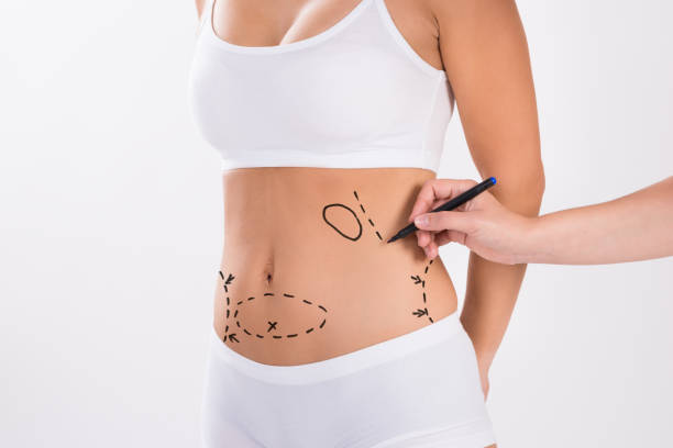 chirurgo che prepara la donna per la chirurgia della liposuzione - liposuction foto e immagini stock