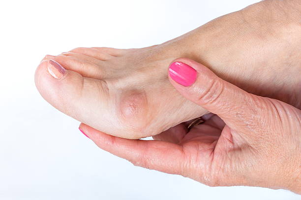 women hand holding the foot with painful bunion stock photo