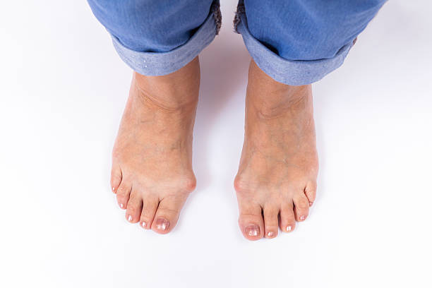 gambe della donna con bunions stare su un bianco - misalignment foto e immagini stock