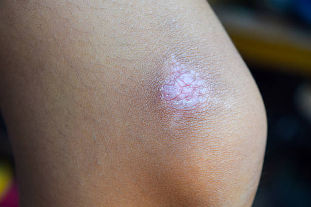istock Scar on the girl's knee 601909198