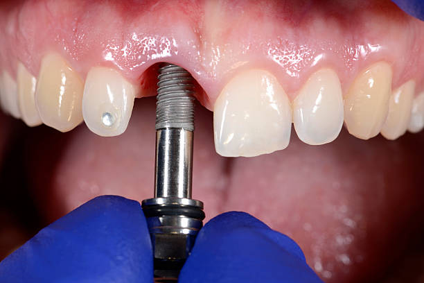 зубной имплантат - teeth implant стоковые фото и изображения