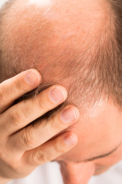 istock Senior man and hair loss issue 601924138
