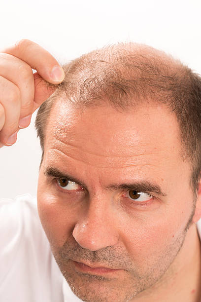 istock Senior man and hair loss issue 601926788