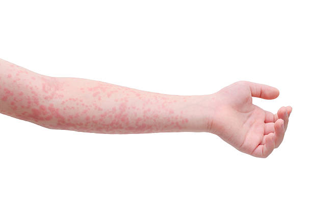 child arm skin with rash over white Young asian child arm skin with rash over white background measles stock pictures, royalty-free photos & images