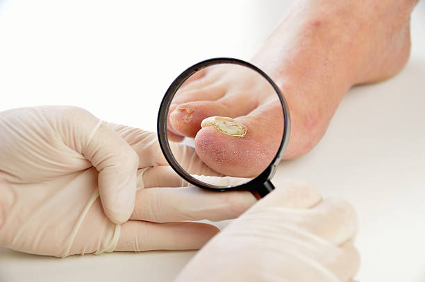 podologist checking the patient foot Closeup image of podologist checking with magnifying glasses the left foot toe nail suffering from fungus infection. horizontal studio picture on white background. ringworm photos stock pictures, royalty-free photos & images