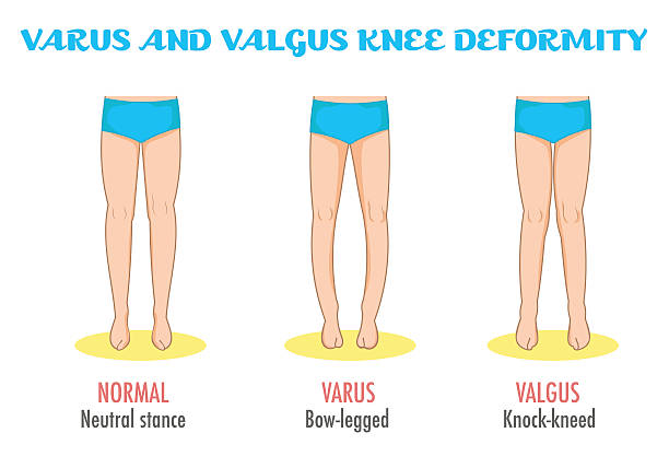 illustrations, cliparts, dessins animés et icônes de valgus/varus genou, maladie des jambes/déformation infographie. - misalignment