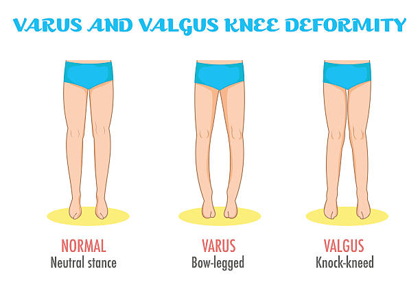 illustrazioni stock, clip art, cartoni animati e icone di tendenza di infografica valgus/varus knee, malattia delle gambe/deformazione. - misalignment
