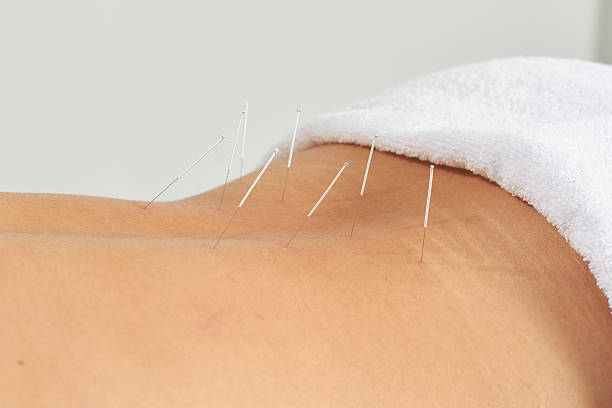 modèle d'acupuncture - surgical needle photos photos et images de collection